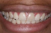 gummy-smile-after