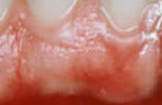 Best Gum Bleaching in Los Angeles Best Gum Bleaching in Los Angeles