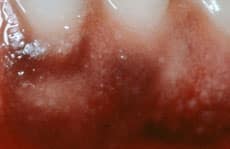 Best Gum Bleaching in Los Angeles Best Gum Bleaching in Los Angeles