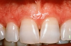 Best Gum Bleaching in Los Angeles Best Gum Bleaching in Los Angeles