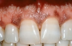 Best Gum Bleaching in Los Angeles Best Gum Bleaching in Los Angeles