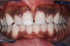 Gum Bleaching Photo